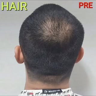 Crown Thinning Reversed in Just 4 Weeks! 👑✨ Non-Surgical Hair Restoration

​Vertex (crown) hair los