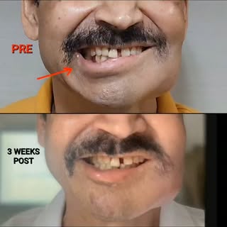 3 Weeks. Perfectly Balanced Smile. Zero Surgery. 💫

​Swipe to see the dramatic improvement in lip s