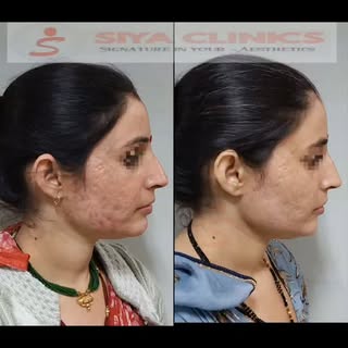 Transforming Acne Scars: Multi-Layer Skin Resurfacing & Control 🔬✨

​Dealing with severe active acn
