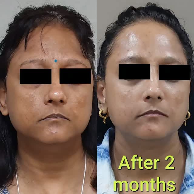 Reversing Facial Hyperpigmentation: A 60-Day Custom Protocol 🔬✨

​Deep epidermal and dermal hyperpi