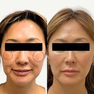 Swipe to see this stunning transformation! ✨

Struggling with melasma, hyperpigmentation, sun spots,