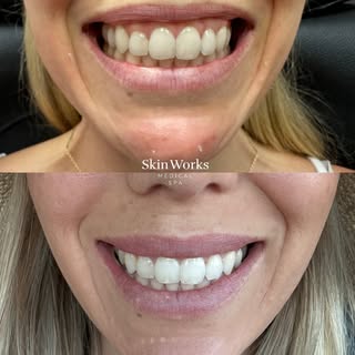 The power of neurotoxins 💉✨ No filler needed to achieve this gorgeous, natural look!

Instead, we u