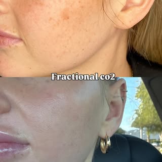 ✨ One Fractional CO2 Treatment, Total Transformation! ✨

Check out this amazing before & after — jus