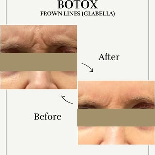 ✨Botox - Frown lines✨

Say goodbye to stubborn frown lines with expert Botox at Skin Works Medical S