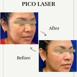 ✨Pico Laser✨

Refresh and renew your skin with advanced Pico Laser at Skin Works Medical Spa. This u