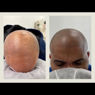 #WellnessWednesday #HairLine #Hair #HairSolution #Bald #MenHair #ThinHair #SMP #scalpmicropigmentati