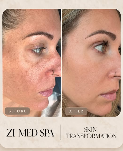 The beauty of combination treatments ✨

Some skin concerns need more than one approach. BBL targets 