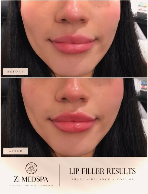 Subtle enhancement, beautiful balance ✨
Lip filler is all about enhancing your natural shape while c