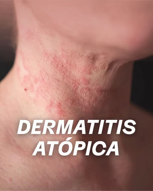 La dermatitis atópica no es solo “piel seca”. Puede causar picazón intensa, enrojecimiento, resequed