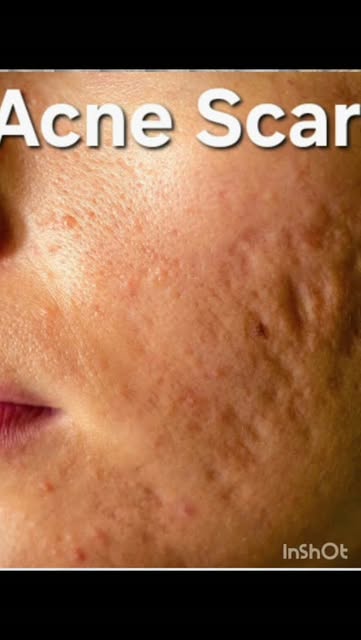 Acne Scar Treatment #acne #acnescar #acnetreatment #acnefighter #drirfanclinics