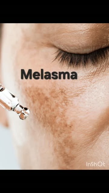 Melasma Pigmentation Freckles #melasma #Pigmentation #freckles #drirfanclinics