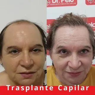 Cambia la cara Cambia la vida
Trasplante + tratamento capilar con #mmpcapilar + #lasercapilar #ledha