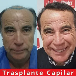 "Cambia la cara Cambia la vida" 
Trasplante capilar en pacientes Hamilton VII, es necesario muchas c