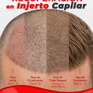 ✨ ETAPAS DE RECUPERACIÓN EN UN INJERTO CAPILAR ✨

¿Te has preguntado qué ocurre después de un injert