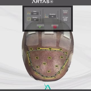 How does a robot know where to place the hairs in the scalp? It orients itself in 3D space using the