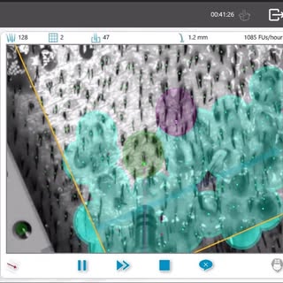 How does a robot “see”? The ARTAS ix uses stereoscopic cameras to detect the density of hair follicl