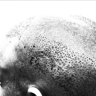 Perm hair. Relocated. 
#artas #hairtransplant #brisbanerobotichairtransplant #brht #venushair #venus