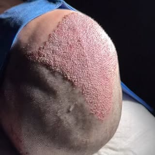 “Precision bald restoration with 9,882 follicles to match the patient’s naturally high hair density 