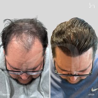 Before & After - 12 months. 

The ingredients for excellent results:
Respect hair angulation and dir