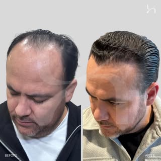 Before & After | Norwood V
12-month hair restoration evolution.
Personalized attention performed exc