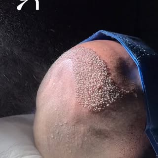 All follicles precisely implanted — respecting angulation, direction, depth, and natural distributio