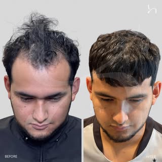 Before & After 12 month progress (aprox 4,950 follicles). 

Before: styling it however you could.
Af