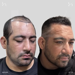 If you’re looking for the most natural hairline possible, you’ve come to the right place. 
.
.
.
.
.