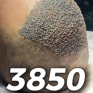 ✌️ High Density Hair Transplant #hairtransplant #hairrestoration #hairloss