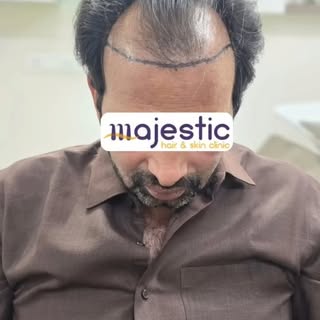 🤔 When do you start looking normal after a hair transplant? #hairtransplant #hairrestoration