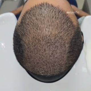Crown Hair Transplant - Majestic Derma #hairtransplant #hairrestoration #hairlosstreatment