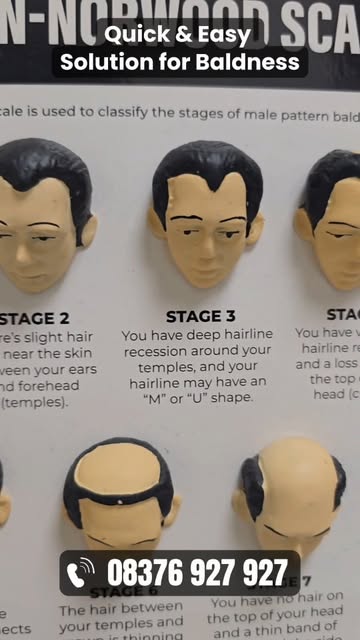 👉 Quick & Easy Solution for Baldness #baldnesssolution #hairlosssolutions #hairreplacement