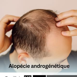L’alopécie androgénétique est l’une des formes les plus fréquentes de calvitie. Elle peut toucher la