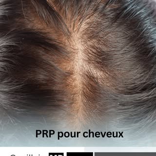 Le PRP pour les cheveux utilise une concentration de plaquettes provenant de votre propre sang afin 