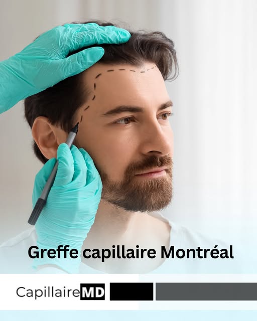 La greffe capillaire peut être une option pour certaines personnes présentant une perte de cheveux s