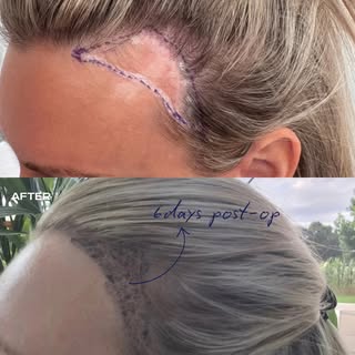 ✨ 6 DAYS POST-OP ✨

A natural hairline starts with precision.

In this female patient, the hairline 
