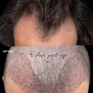 9 DAYS POST-OP — HAIR TRANSPLANT

A new hairline can completely change the balance of the face.

Thi