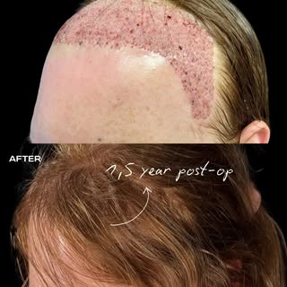 1.5 YEARS POST-OP — FUE HAIR TRANSPLANT

A result worth sharing.

For this patient, 4,000 grafts wer