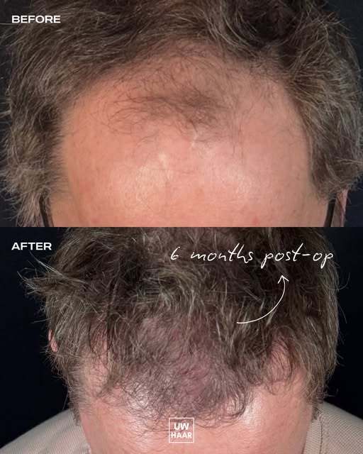 Six months ago, this patient rarely went outside without a cap.

Hair loss had slowly taken away a p