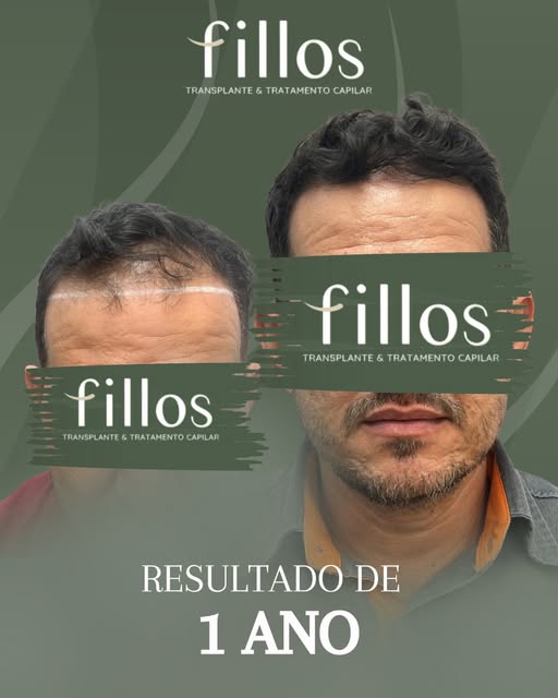 Duas imagens, uma grande transformação!!
É isso que a Clínica Fillos faz!

Responsável técnica: Dra.
