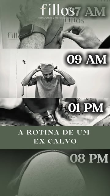 Responsável técnica: Dra. Mirley Arantes Monteiro/ CRM:32.609/ RQE:26008

#transplantecapilar #calvi