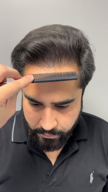 Zoomed-in combing 🪮 of the hairline and donor area.
Anyone can show you results from far apart, wit