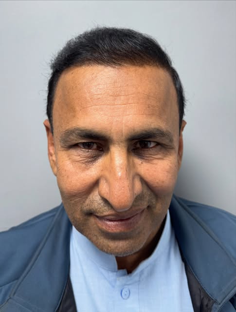 13 months post hair transplant result.

Type of baldness: Grade 7 Norwood
Donor: Head and beard 🧔🏻