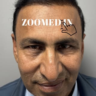 Zoomed-in combing 🪮 of the hairline.

Restoring a hairline can never be 100% as dense as natural ha