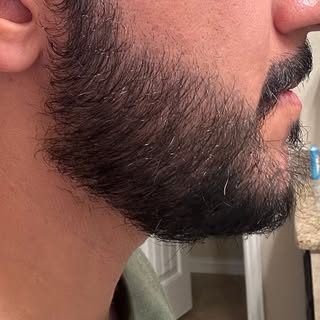 Beard and moustache transplant – 12 months after the procedure.

Type of procedure: Beard transplant