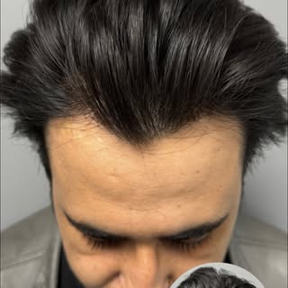 Long Hair FUE – 3 days post-op pictures.

Procedure type: Long Hair FUE to cover Grade 2 Norwood.

P
