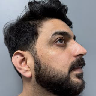 8 months post beard transplant result.

Type of procedure: Beard hair transplant plus scar excision 