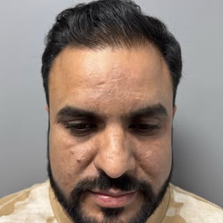 9 months post hair transplant surgery result.

Procedure: Front + Vertex/Crown
Type: Grade 5–6 Norwo