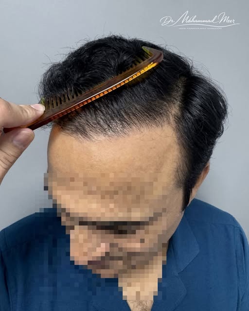 Restoring a complex cowlick 🐄👅 hairline and temples.

8-month result of a cowlick hairline plus te