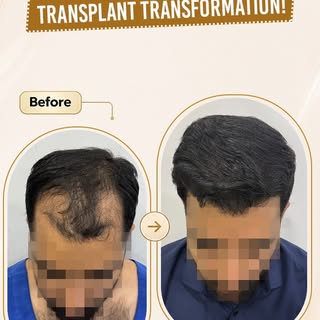 Hair loss can affect confidence, but with the right expertise, a natural-looking transformation is p