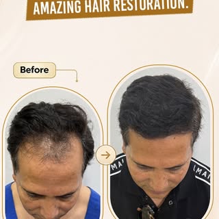 Meet Rafiq Nawaz, who underwent a 4040-graft Hair Transplant at MedRootz. Today, after 1 year and 3 